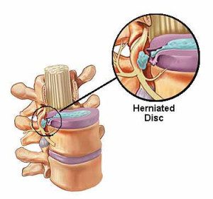 herniated disc back pain relief