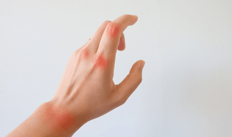 Physiotherapy For Rheumatoid Arthritis