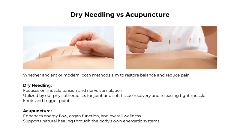 dry needling vs acupuncture