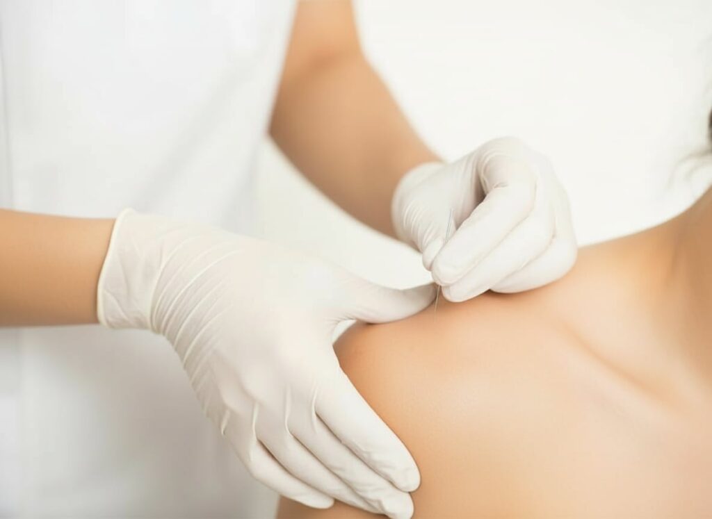 dry needling Toronto