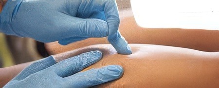 dry needling physiotherapy Toronto