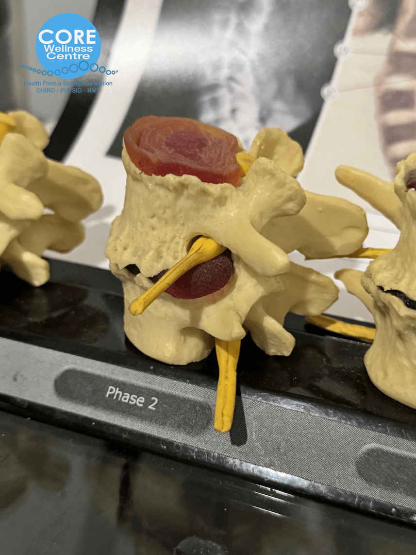 phase 2 disc herniation